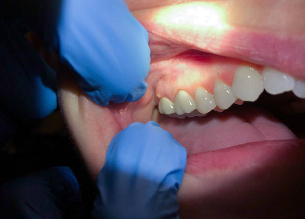 Best Emergency Treatment for Dental Infections or Abscesses in Calverton, NY