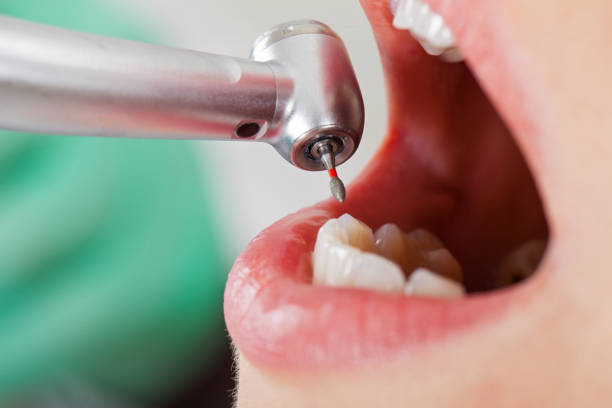 Best Emergency Tooth Extraction in Calverton, NY